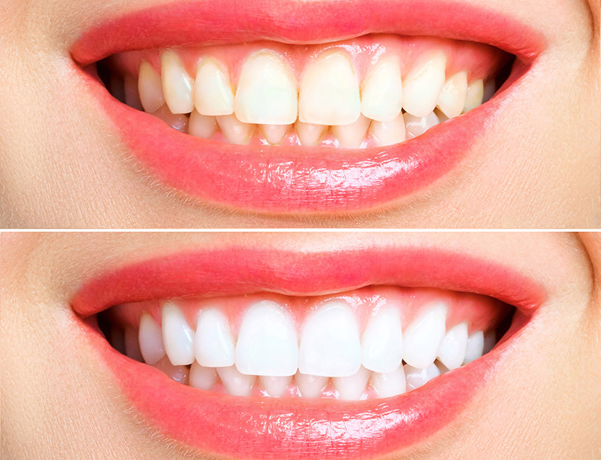 Sbiancante dentale prima e dopo 