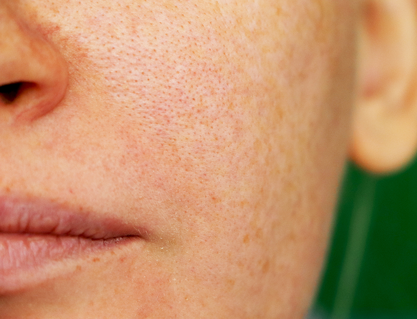 Come minimizzare i pori dilatati